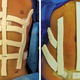 (Left) Intraoperative view with TopiFoam in place for a male patient. (Right) Intraoperative view with TopiFoam in place for a female patient.